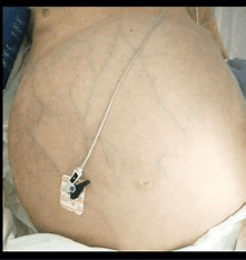 Distension of Abdomen - Image 1