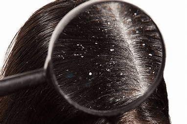 Dandruff - Image 1