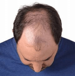 Hair Loss (Khalitya) - Image 2