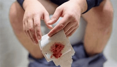 Bulging of Rectum - Image 2