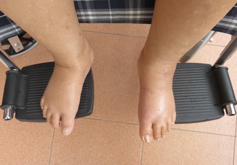 Swelling in the Legs or Ankles - Image 1
